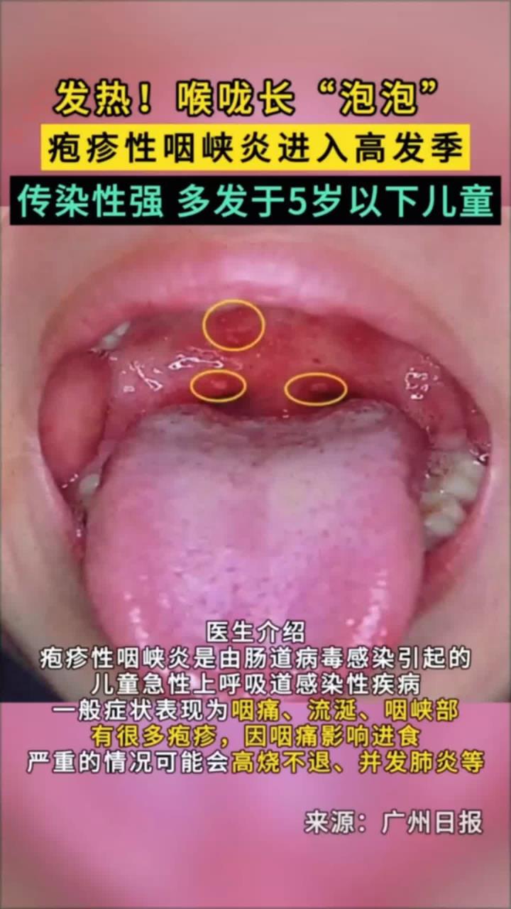 喉咙长泡泡,疱疹性咽峡炎进入高发季
