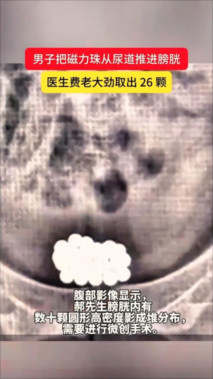 磁力珠为啥塞尿道_磁力珠有什么伤害（磁力珠能不能排出来）