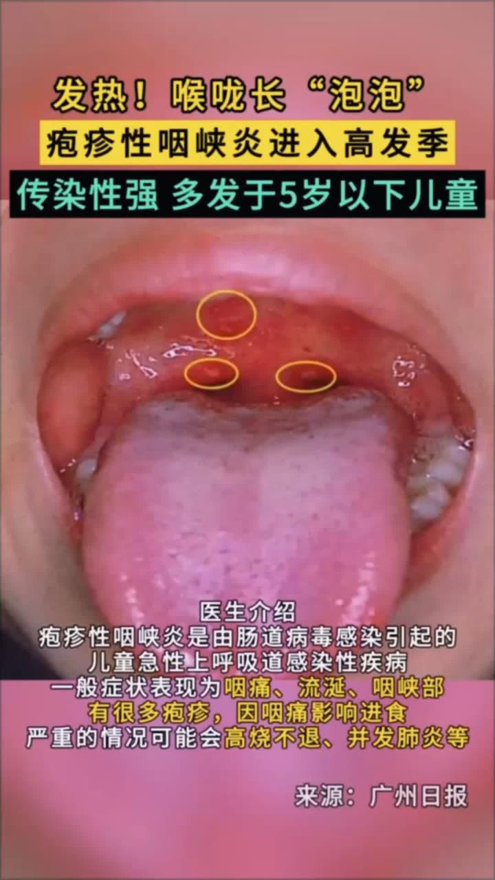 喉咙长泡泡,疱疹性咽峡炎进入高发季