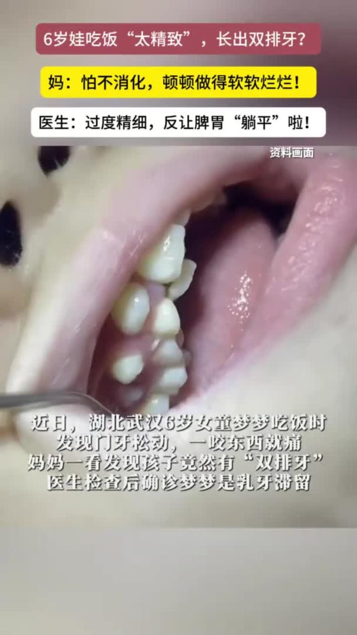 6岁女童吃得太精细长出"双排牙"!