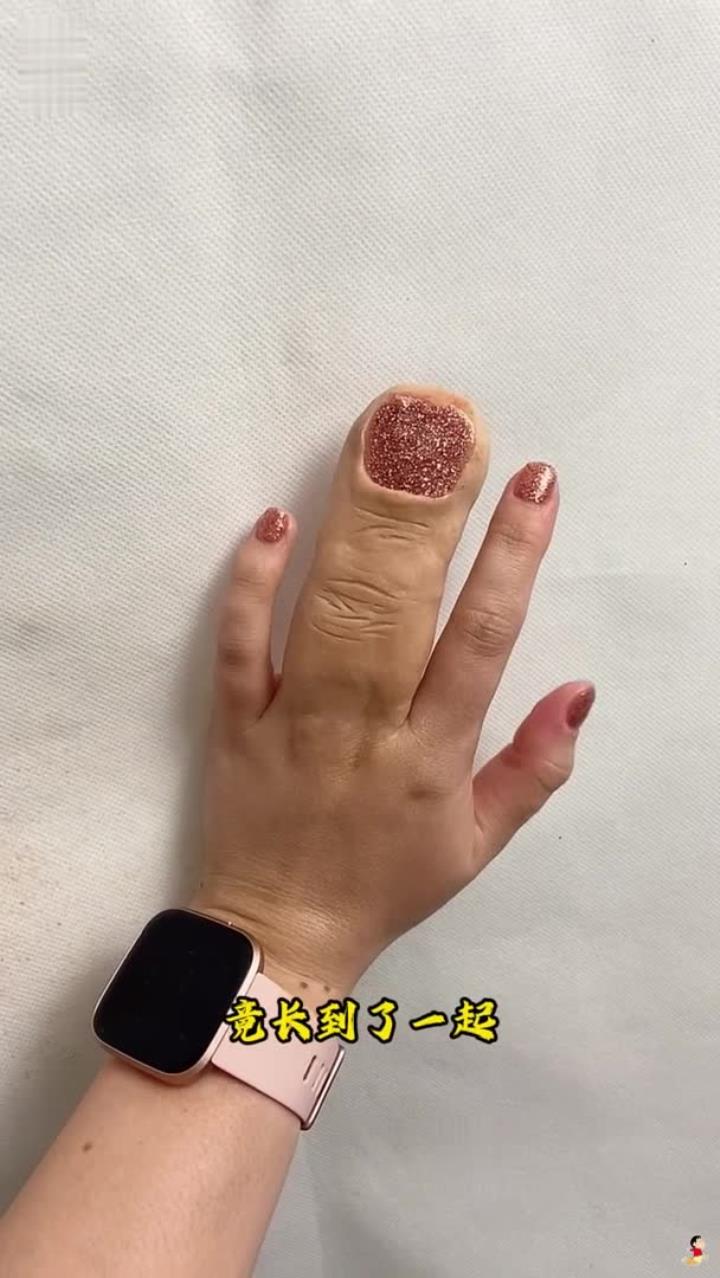 女子的中指和食指长到了一起,她并不是得了什么怪病!