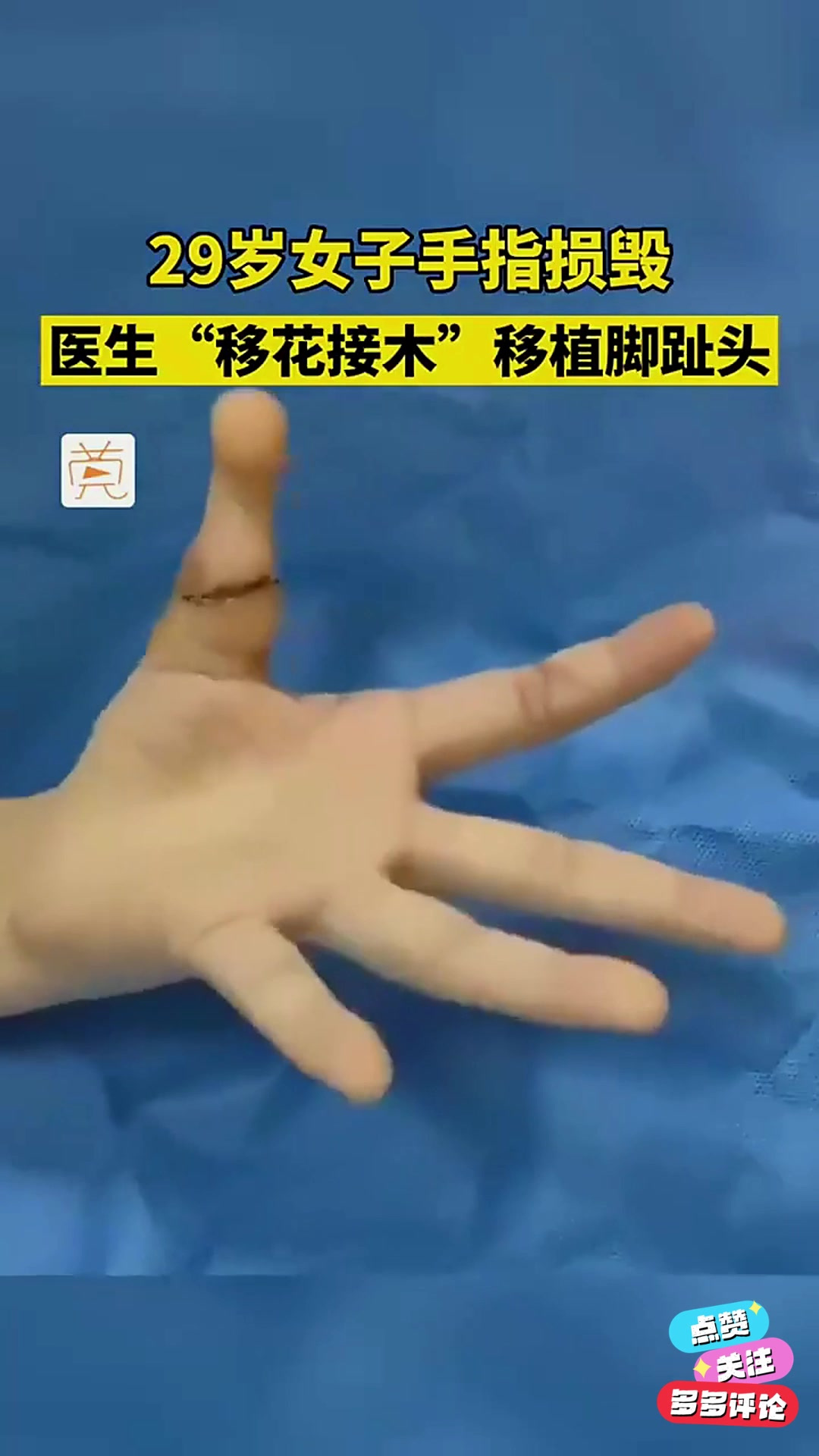 女子手指损毁,医生巧手移植脚趾成功再造