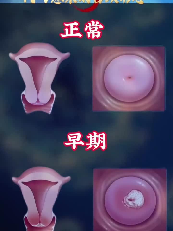 hpv感染的宫颈形态