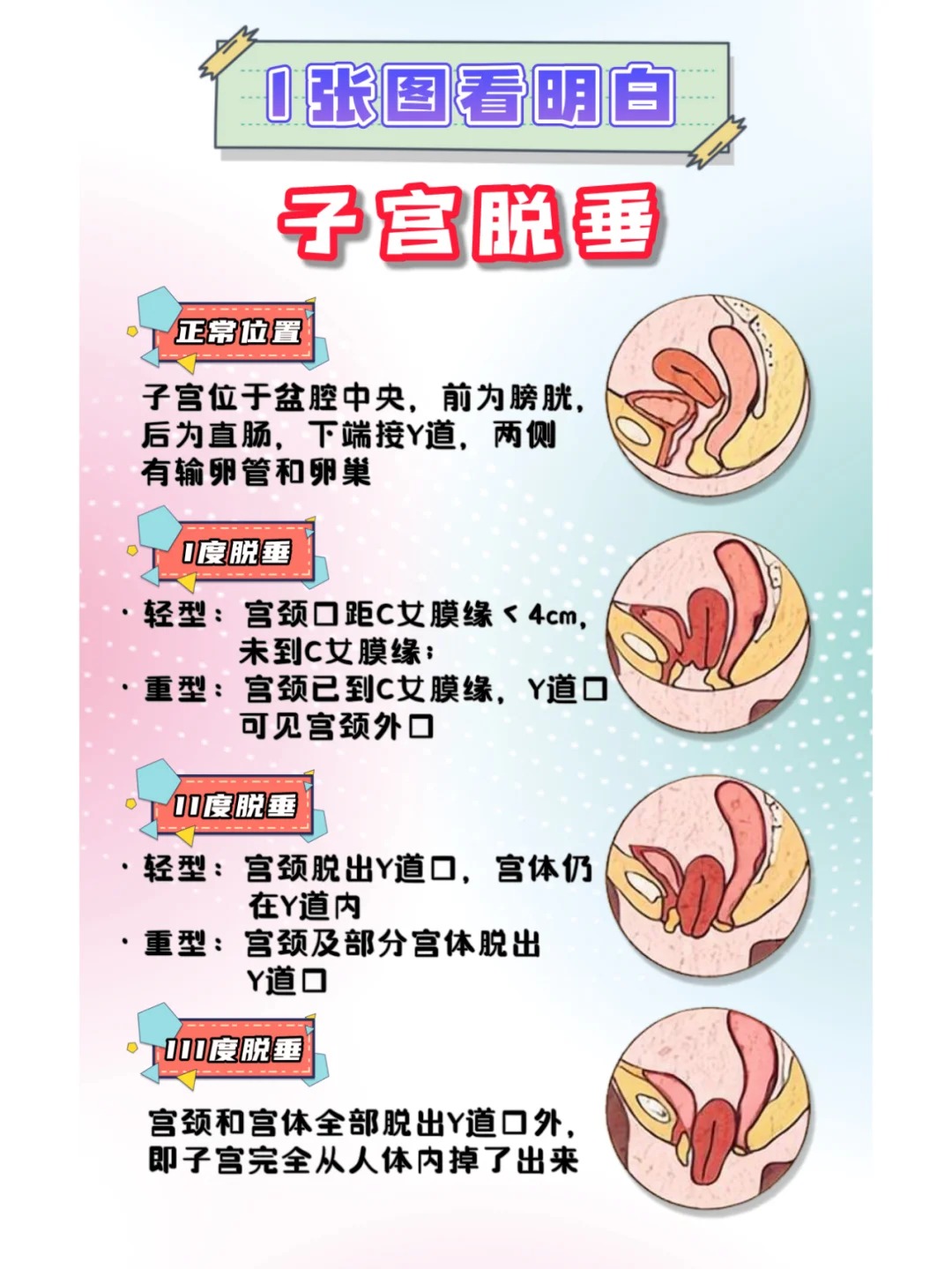 子宫膨出和脱垂怎么治疗 子宫膨出和脱垂是女性盆底功能障碍的常见