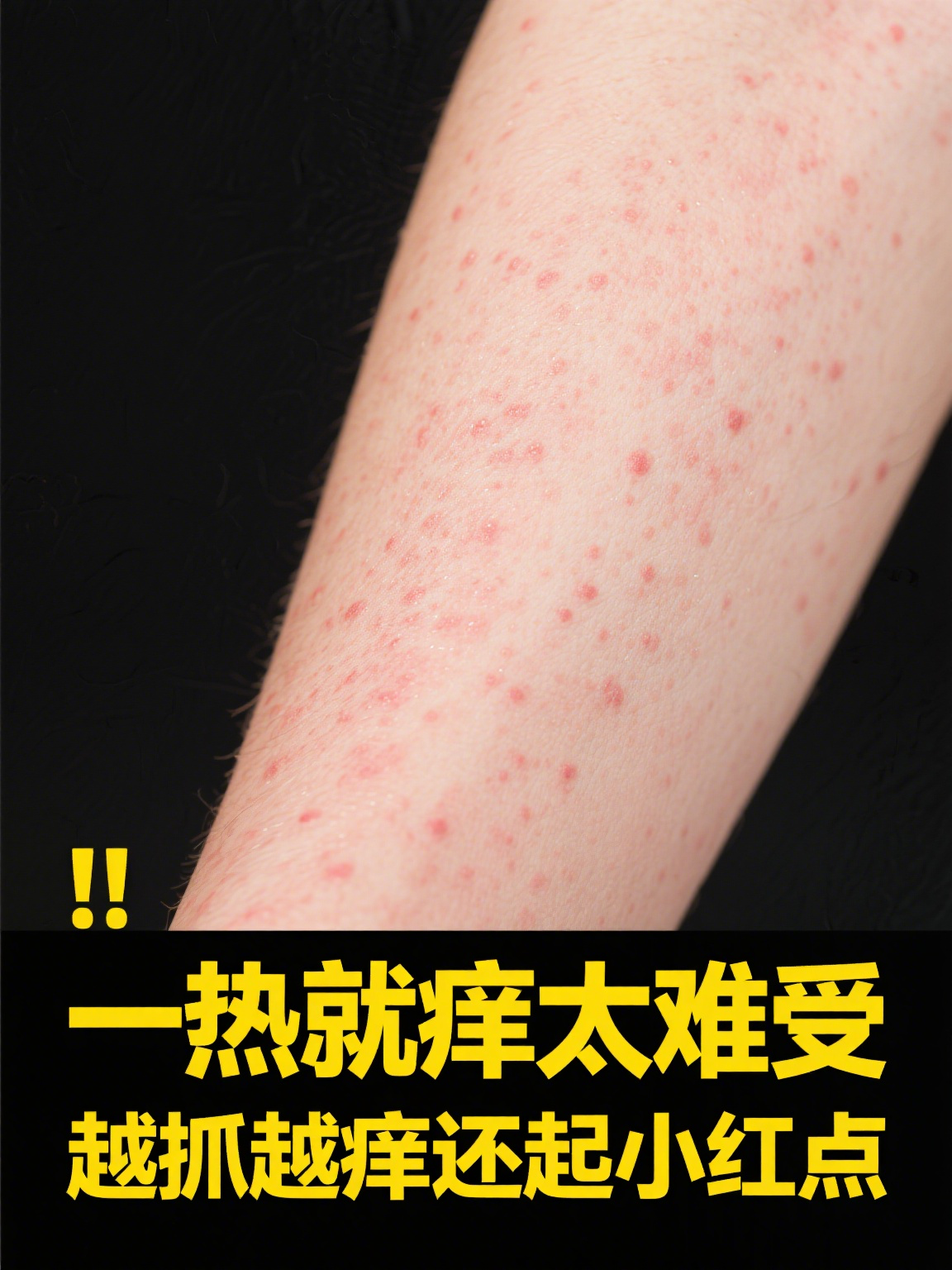 为什么得胆碱性荨麻疹