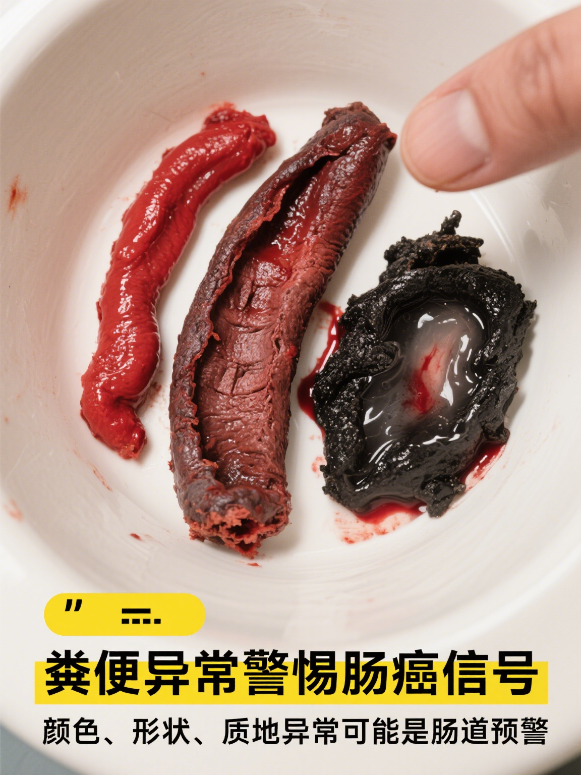 肠癌早期粪便图片 肠癌早期,身体可能会悄悄通过粪便传递信号虽说仅凭