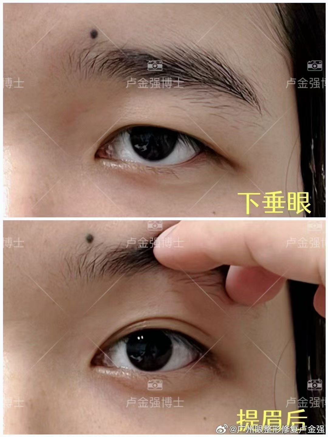 这种情况直接做双眼皮会导致眉眼间距近 眉毛压眼球的结果 建议是先做