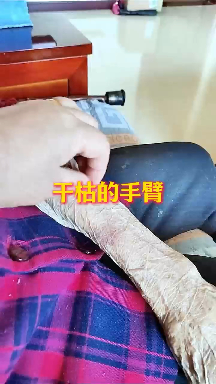 老人的胳膊上只有皮没有肉,干枯的手臂让人看着心疼!