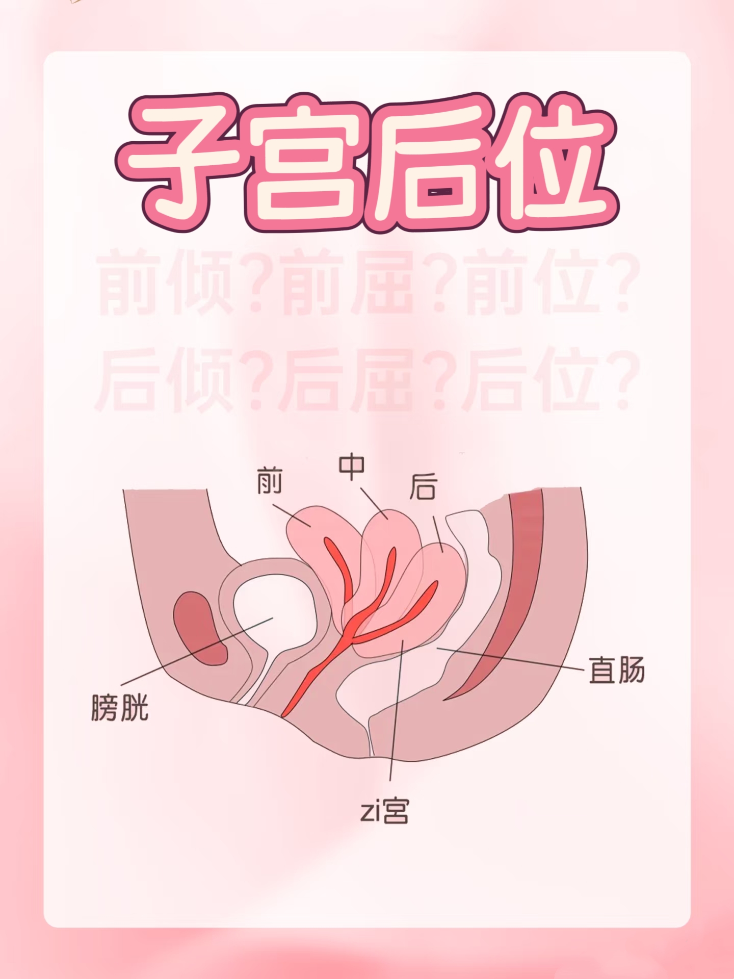 子宫后位是女性常见的子宫位置之一,指子宫向后方倾倒,宫颈