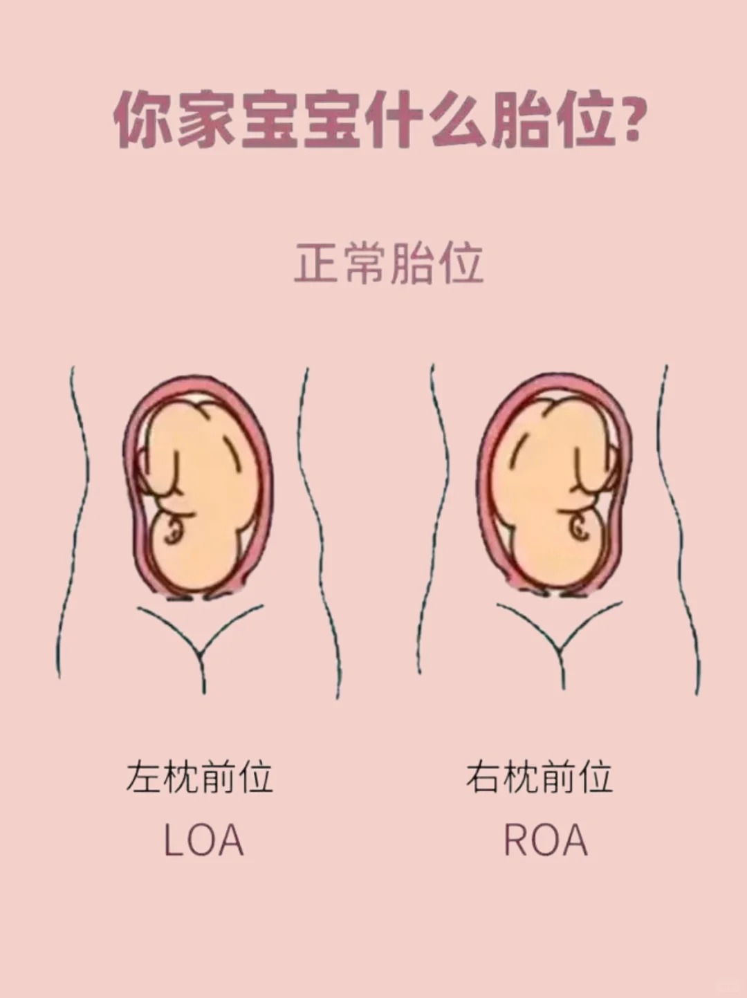 这是孕期产检中常提到的胎位术语,不少准妈妈看到会有些疑惑