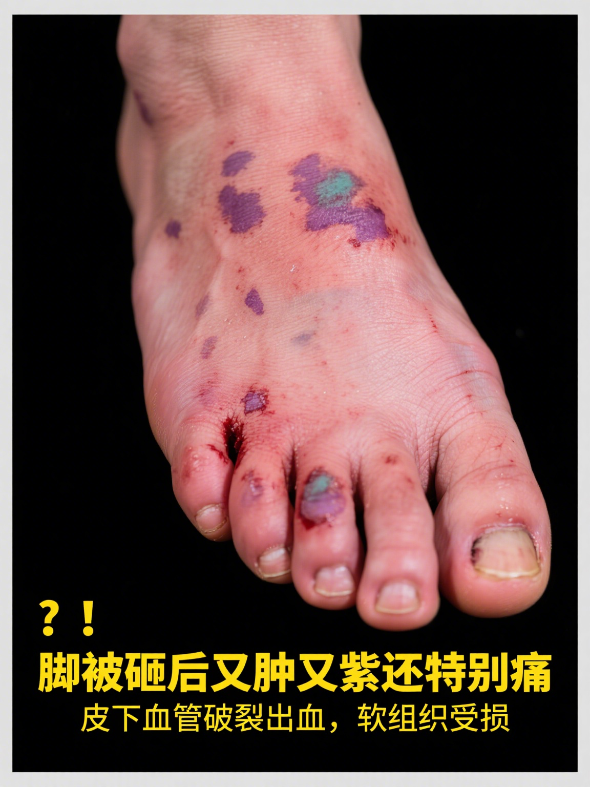 脚砸了肿了紫了有淤血很痛怎么办
