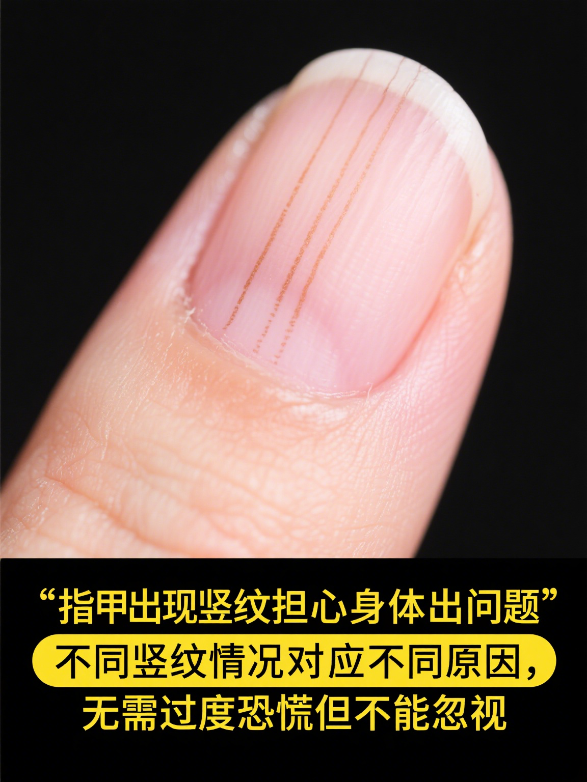 指甲有竖纹是身体的什么原因 指甲上出现竖纹,不少人会担心是不是身体