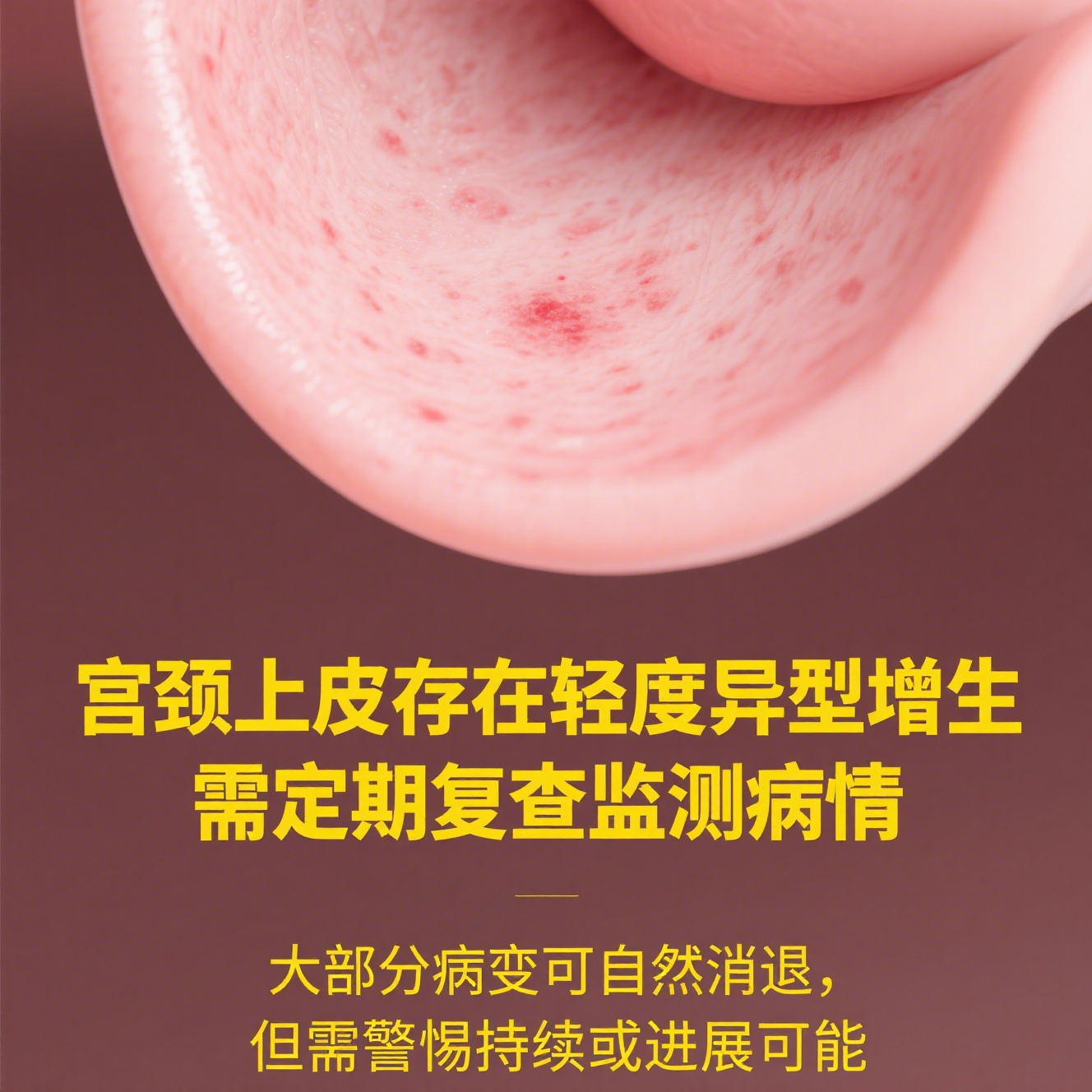 这表明宫颈上皮存在轻度异型增生,不过别担