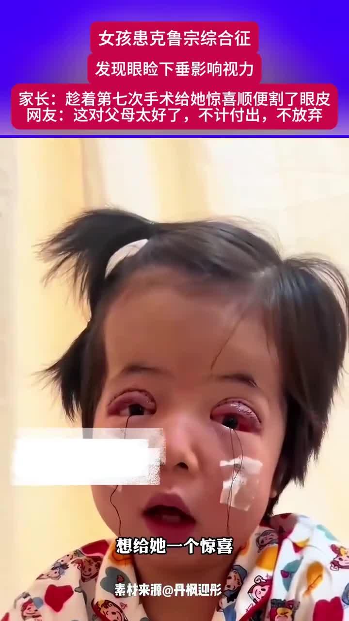 女孩患克鲁宗综合征发现眼睑下垂影响视力