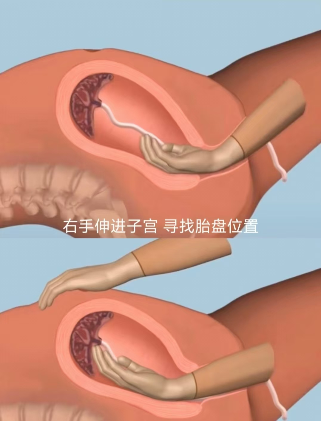 把拳头从子宫内生出来
