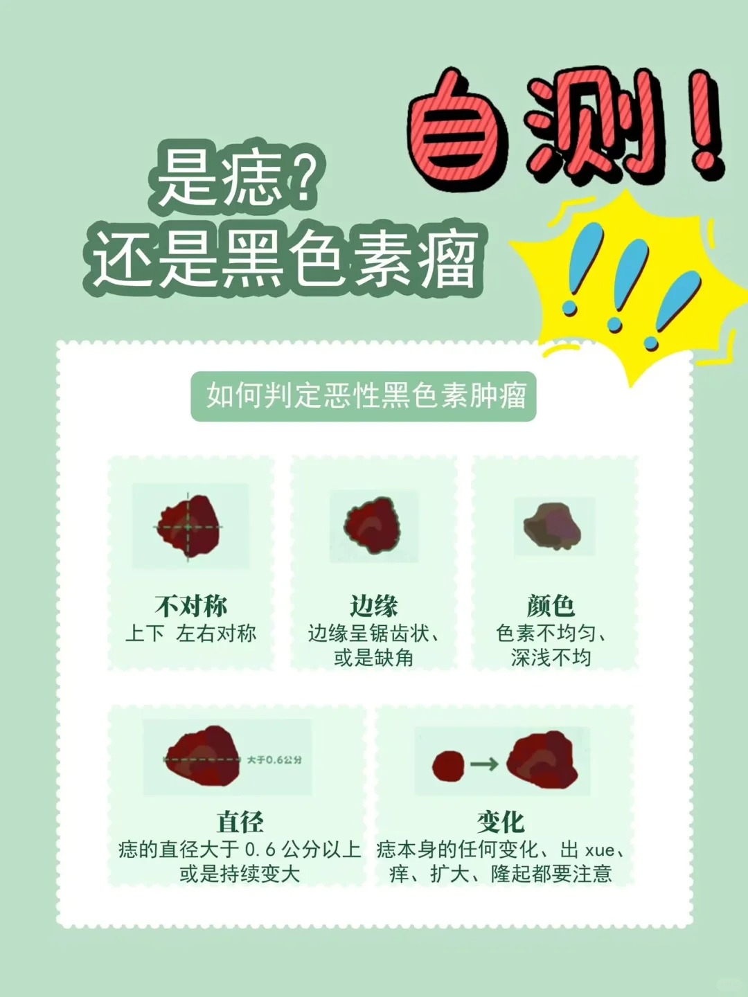 黑色素痣 黑色素痣是由一群良性的黑色素细胞聚集而成的皮肤表现几乎