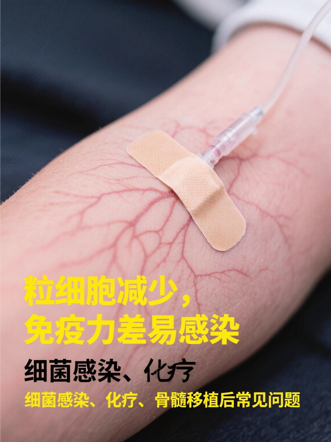 gcsf gcsf即粒细胞集落刺激因子,是一种由人体细胞分泌的蛋白质激素