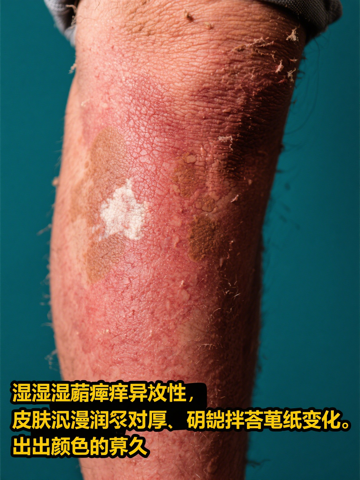 湿疹是一种常见的皮肤疾病,常常让患者苦不堪言