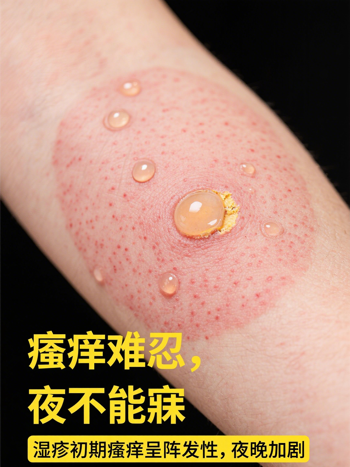 湿疹刚开始的样子 湿疹初起时,皮肤常率先发出"警报"