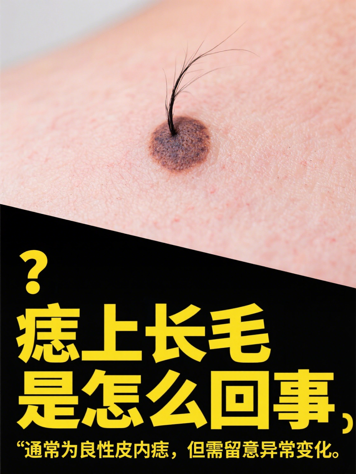 痣上长毛,是怎么回事?