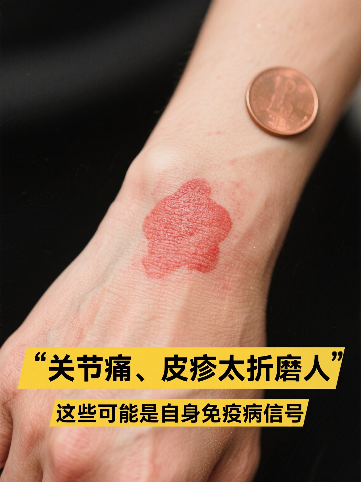 抗核抗体:自身免疫病的"信号灯" 抗核抗体