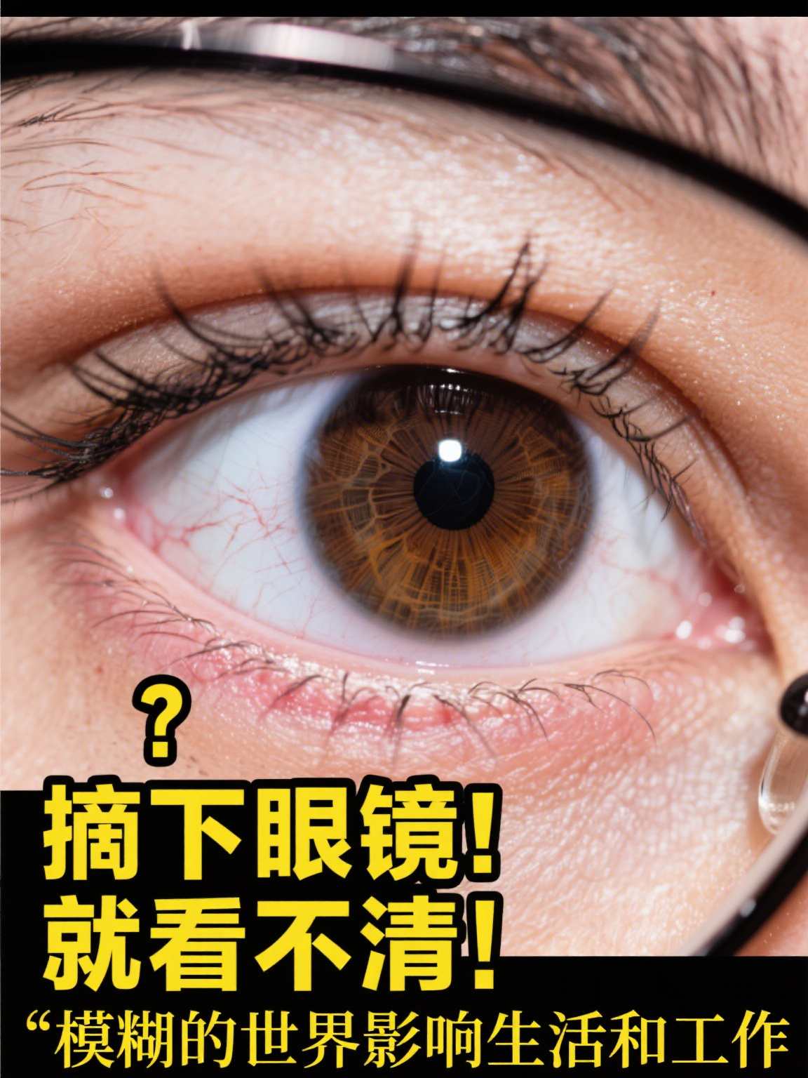 近视矫正手术 近视矫正手术是通过医疗手段改善眼球屈光状态,帮助近视