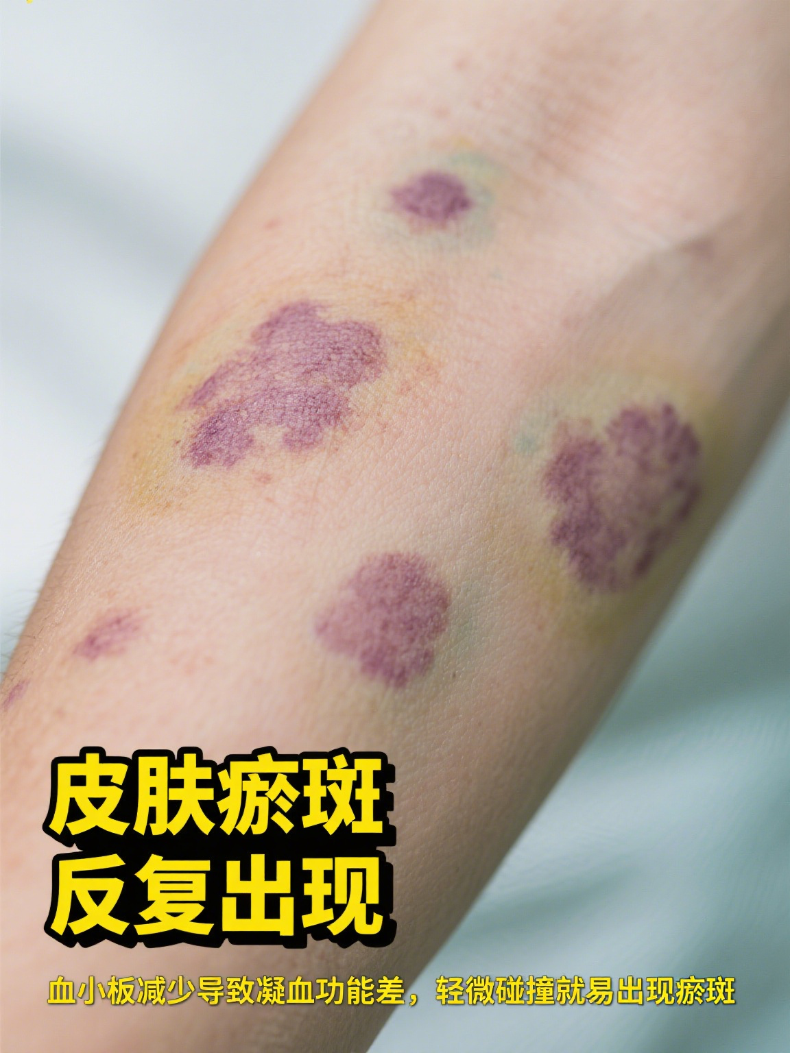 当人体血小板数量过低时,可能出现皮肤瘀斑,牙龈出血等症状,严重时