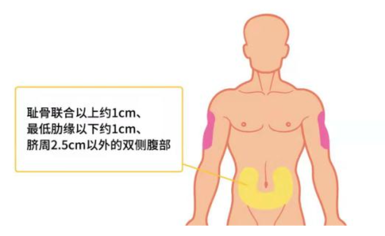 胰岛素注射部位详解(部位一:腹部)