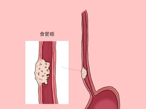 吃飯的時候吞嚥困難——瞭解食道癌的症狀和外科治療方法