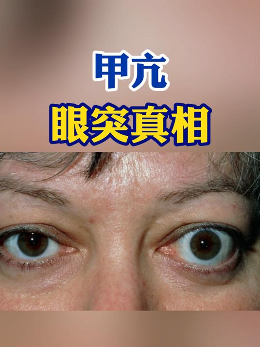 甲亢,眼突真相,你知道吗