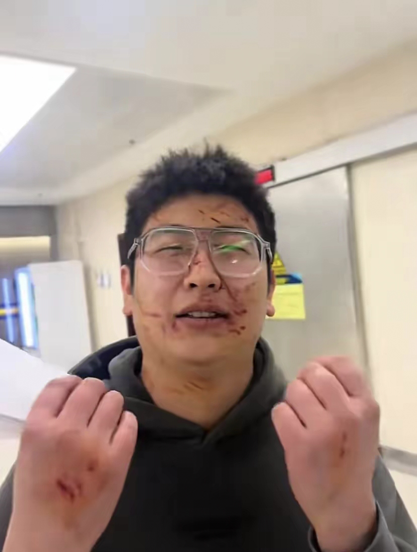 受伤照片男子被"黑寡妇"近亲咬伤真实被打伤了的图片被打之后的样子