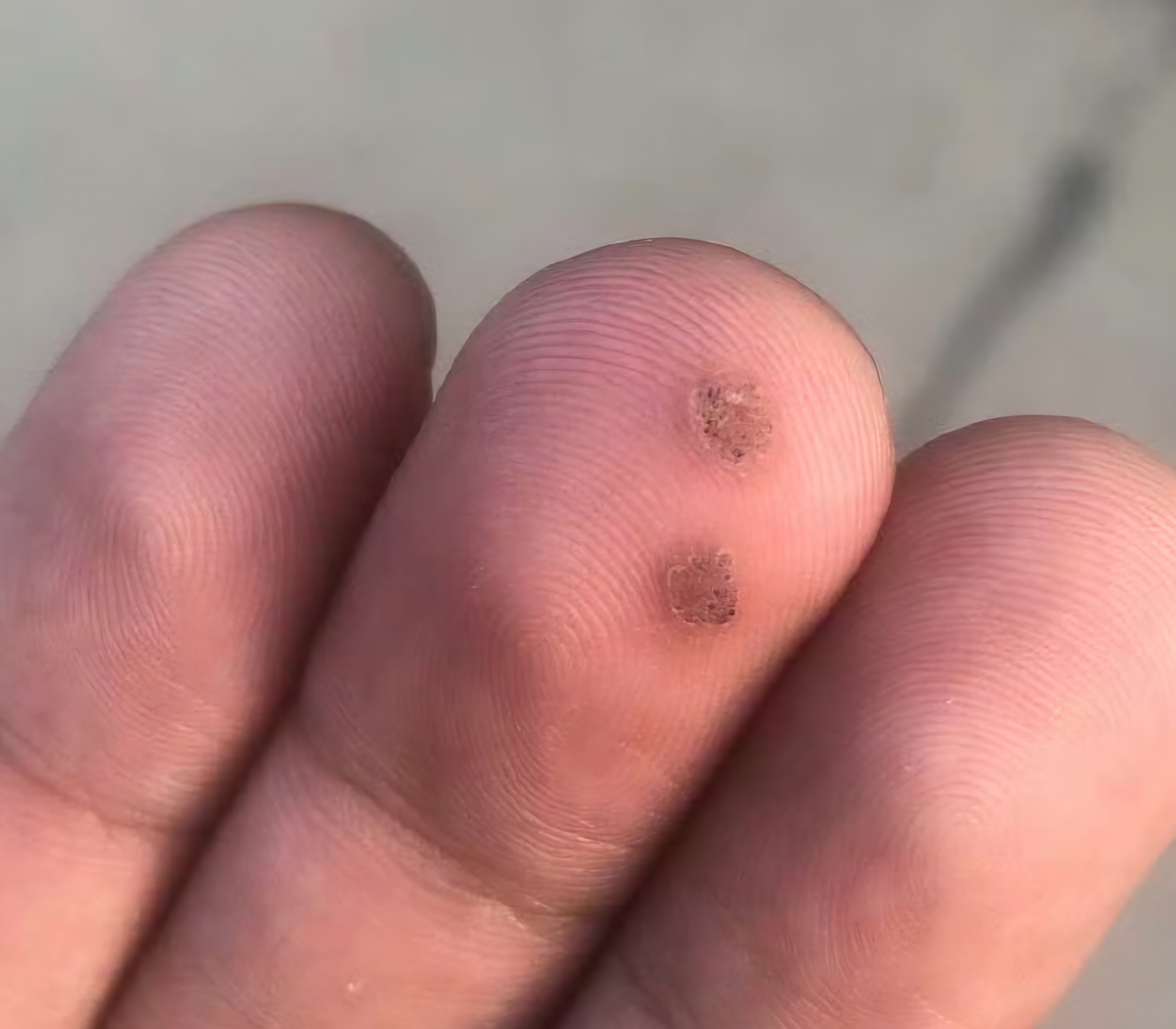 手上如果长了寻常疣怎么办?