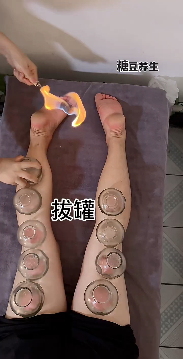 给双腿拔火罐让自己走路更加灵活,不知道你们有没有体验过呢