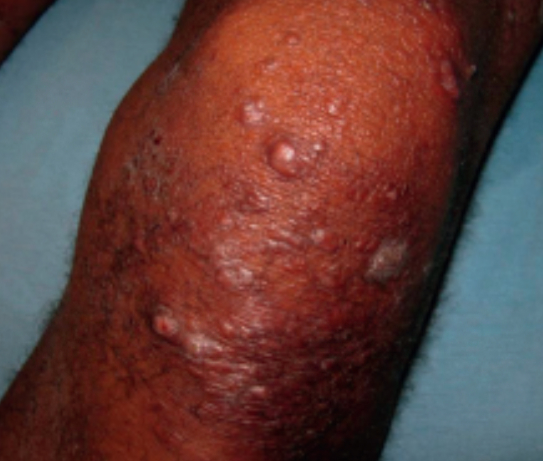 麻风病图片,如何预防麻风病?