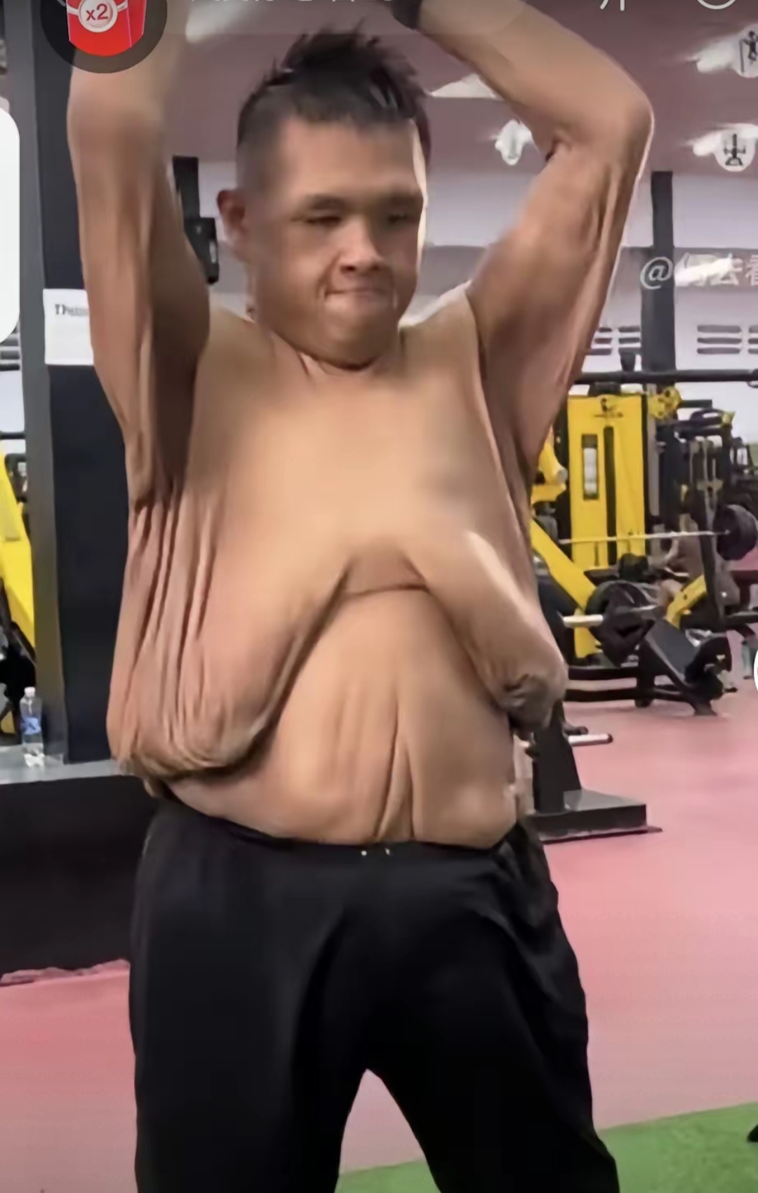 真让人好奇,这多出来的皮肤,会不会做手术割掉呢?