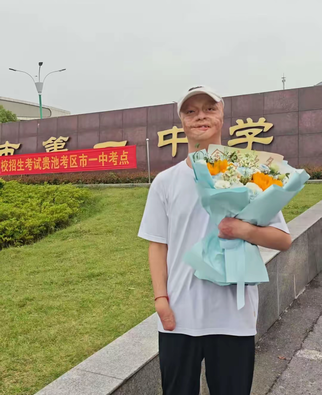 安徽这位"烧伤男孩"的故事,堪称现实版的励志传奇