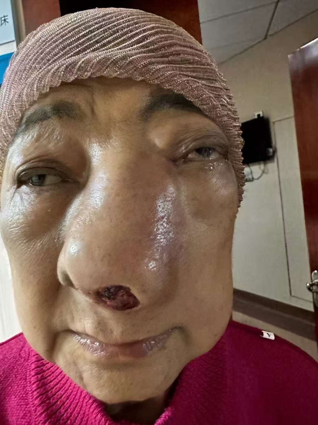 恭喜新疆哈族患者,当地确诊鼻咽癌,来我院治疗到出院!