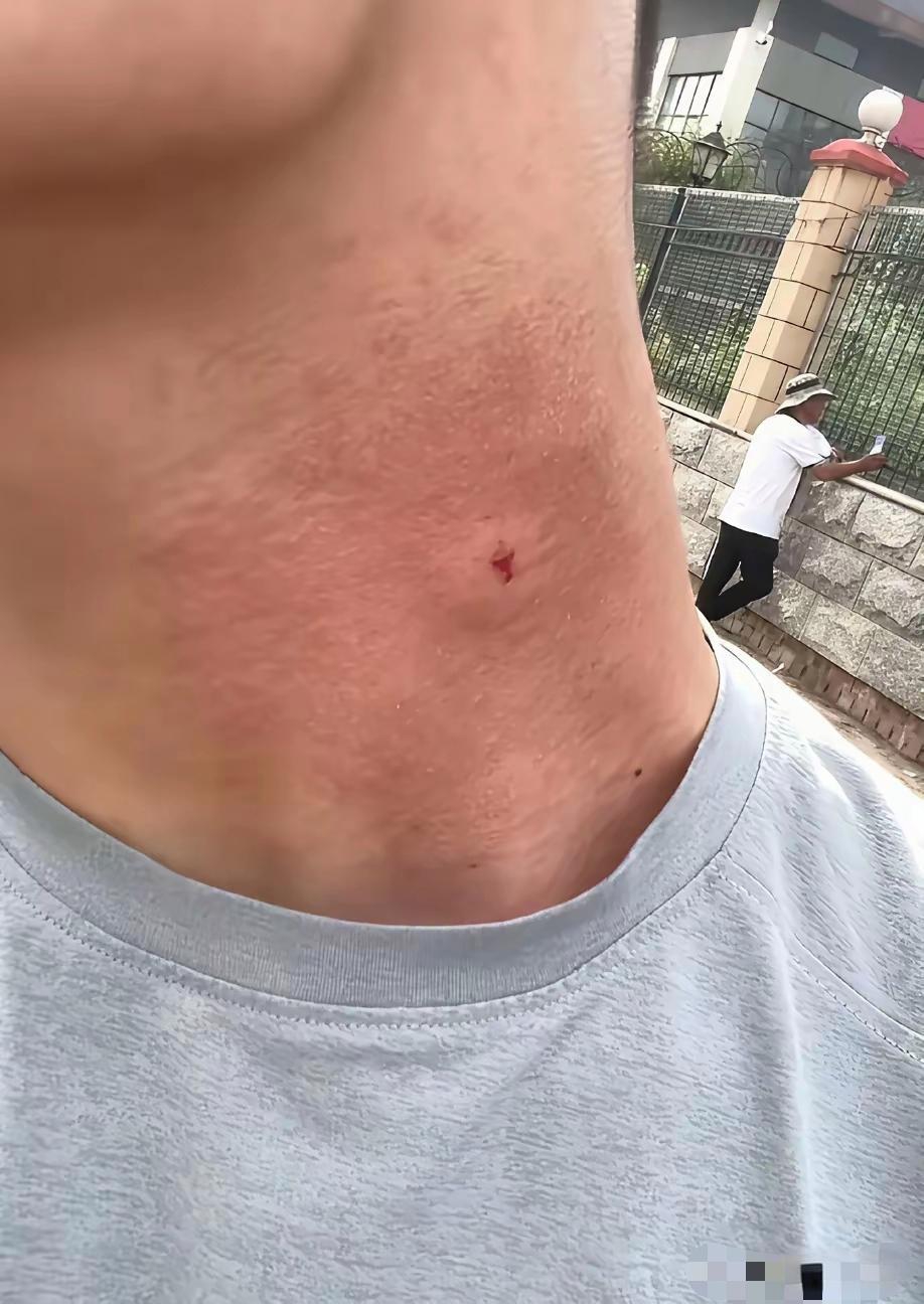 高考语文前40分钟,这考生被一只马蜂给蛰了,在考场里都差点