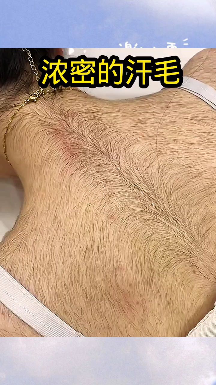 浓密的汗毛,没有合适的去除办法吗?