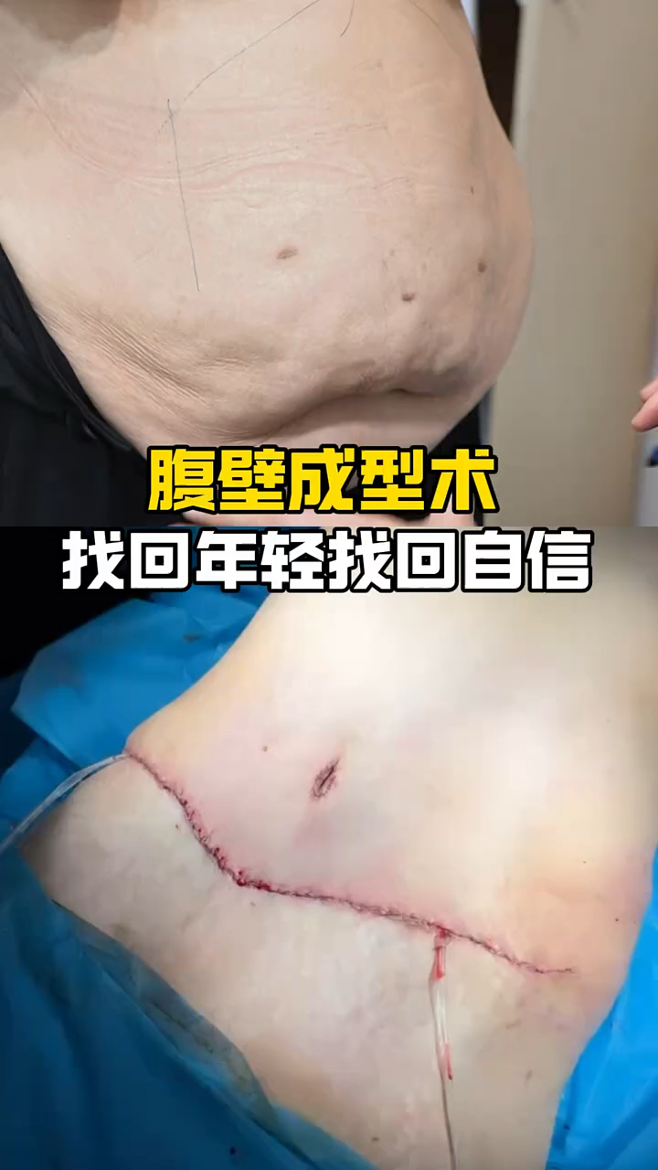 腹壁成形术找回年轻时的自信