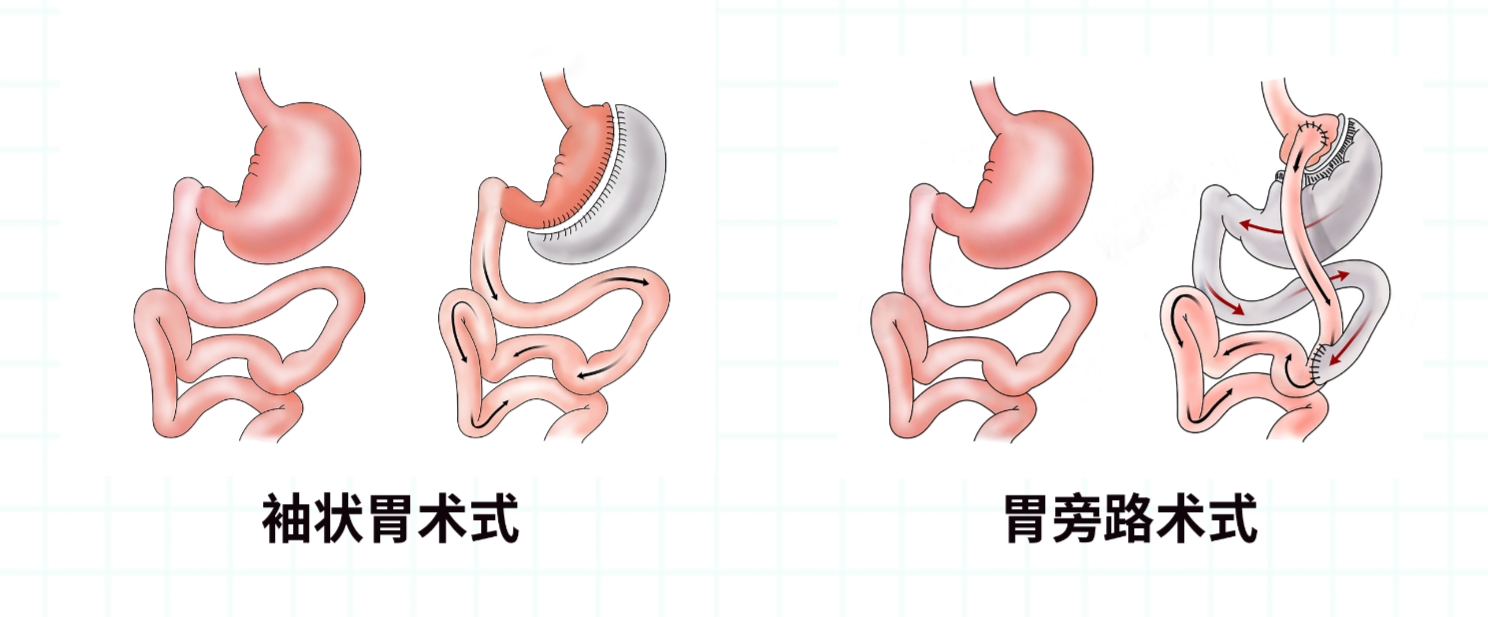 "空肠回肠吻合术"傻傻分不清楚?