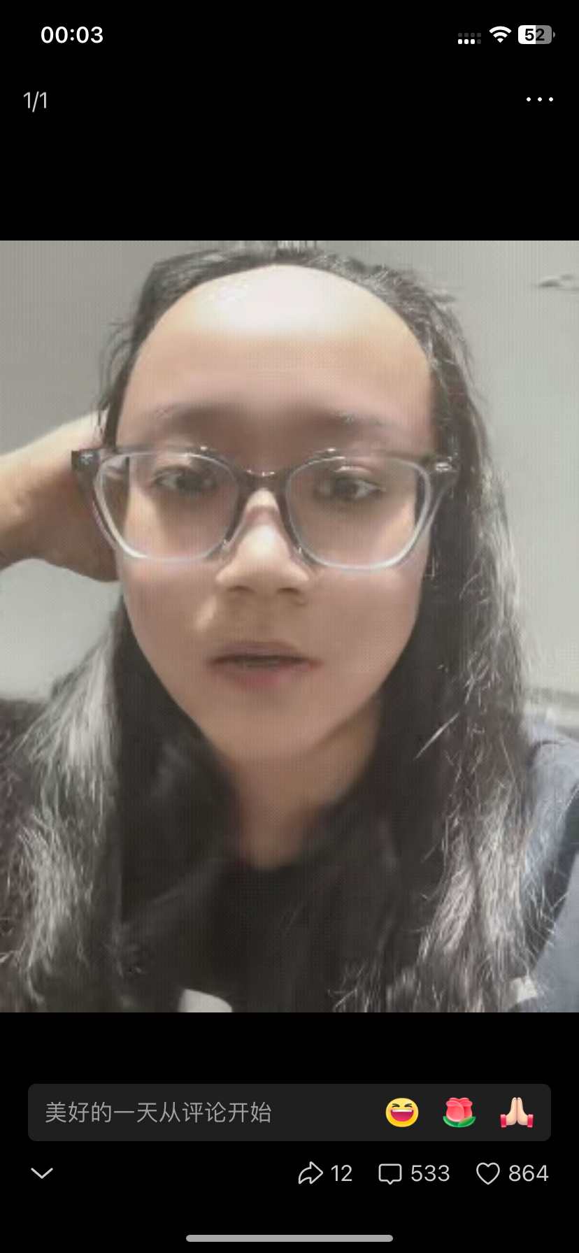 浙江一女子天生大额头,发际线高,头发根本遮不住,每次拍照,那脑门亮得