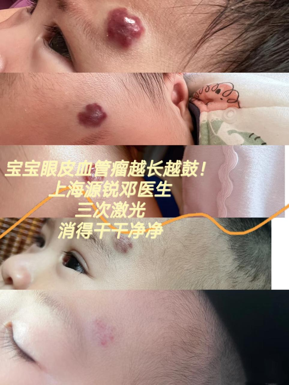 宝宝眼皮血管瘤3次激光消得干干净净