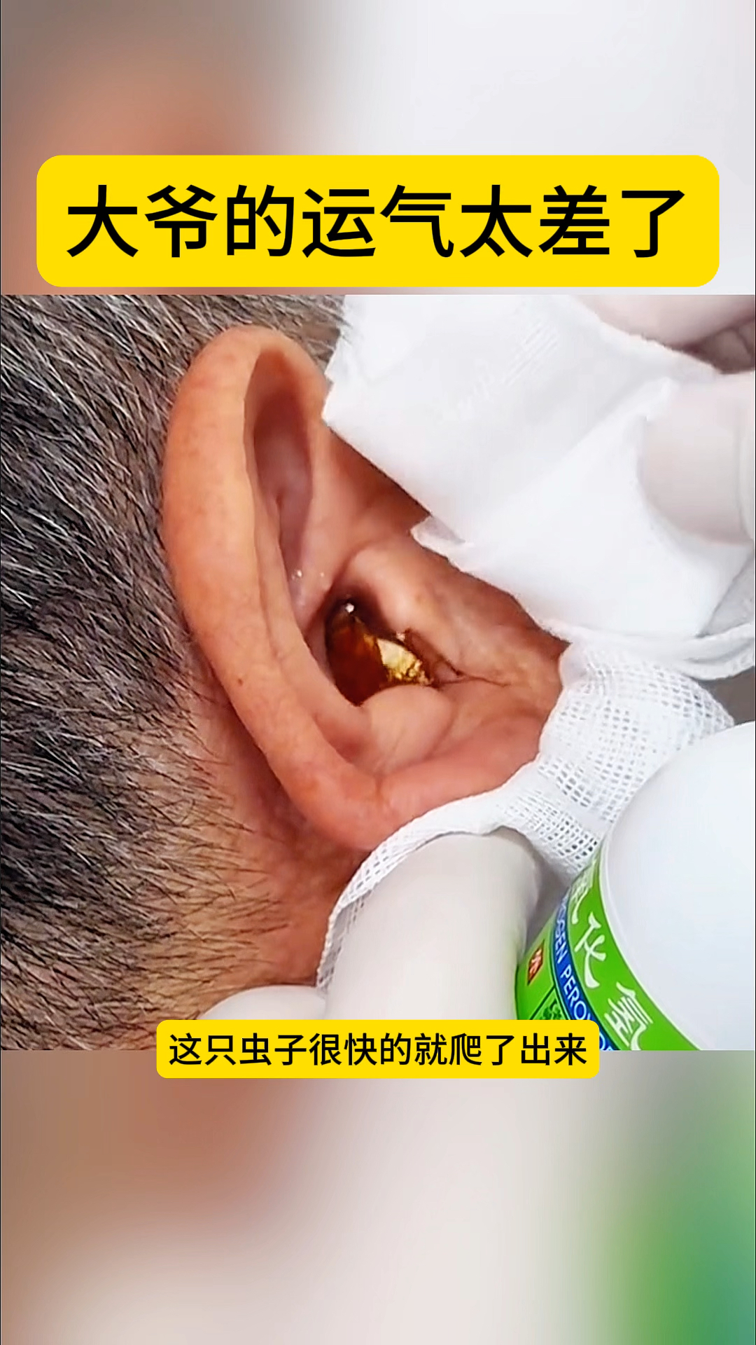 大爷的运气太差了,在睡觉的时候耳朵里居然爬进去一只虫子