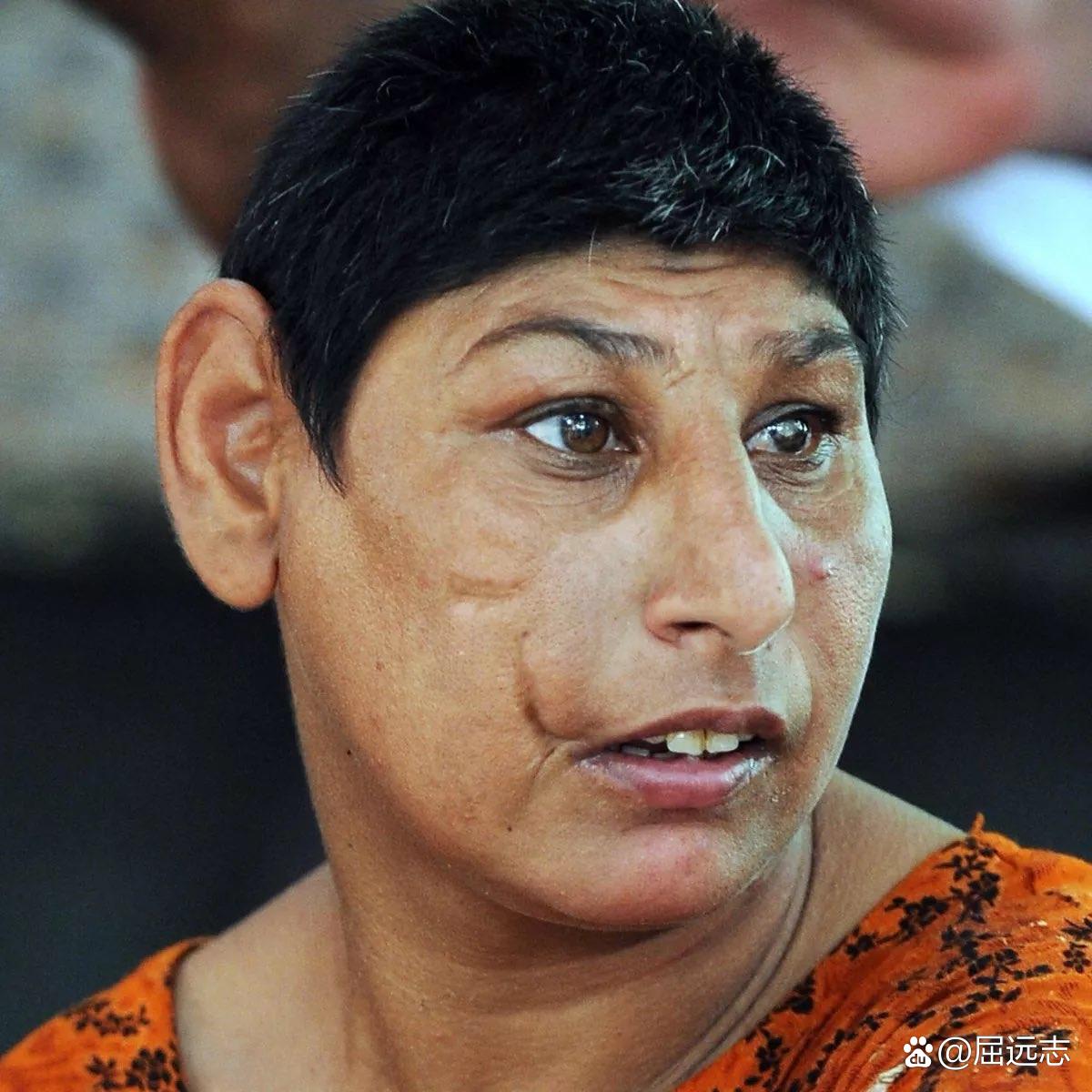 巴基斯坦的鼠孩是患有小头畸形的个体,经常在圣沙多拉神殿被当做乞丐