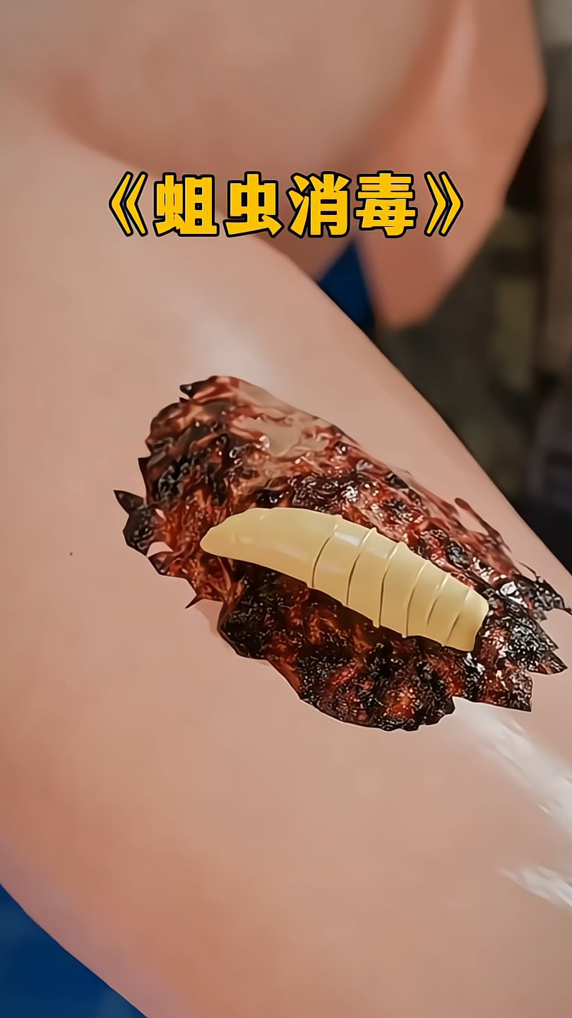 蛆虫真的可以消毒吗?