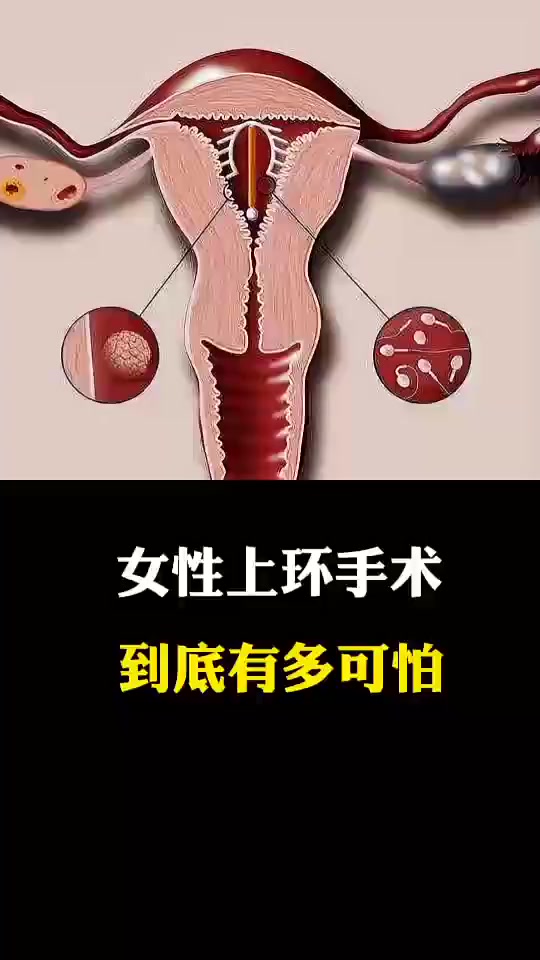 每日科普:女性上环手术