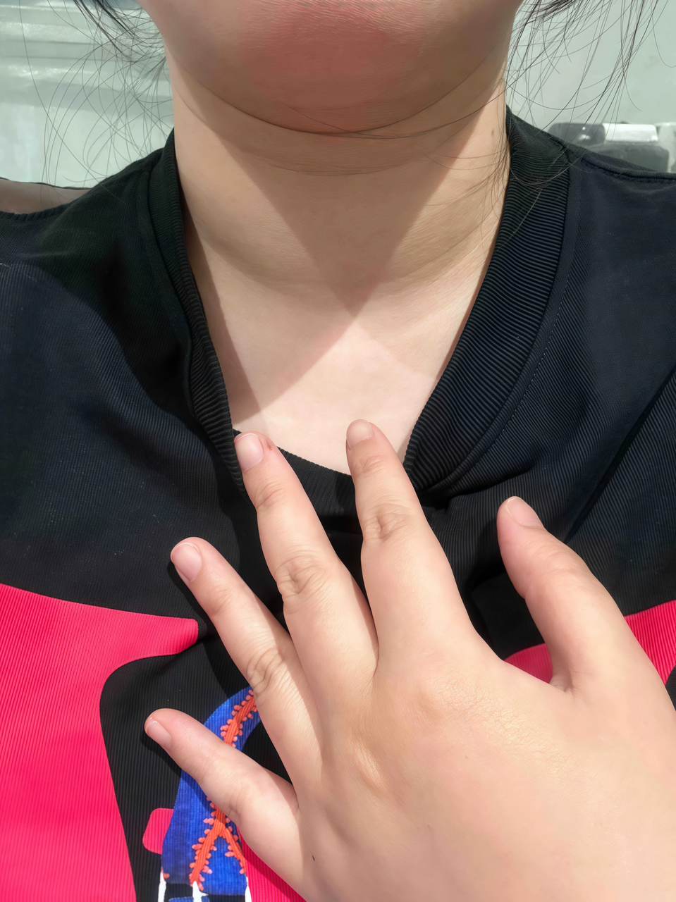 甲亢的脖子真的不会变小了吗