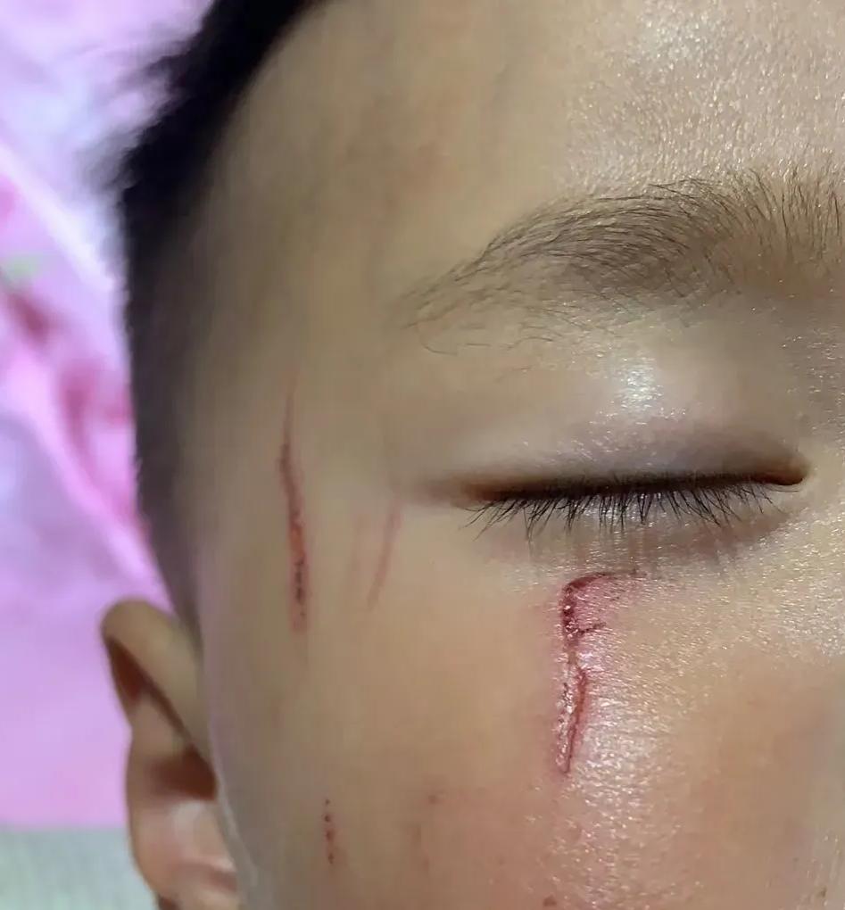 今天下班回家看到儿子的脸在幼儿园被别的小朋友抓成这样,我老公那个