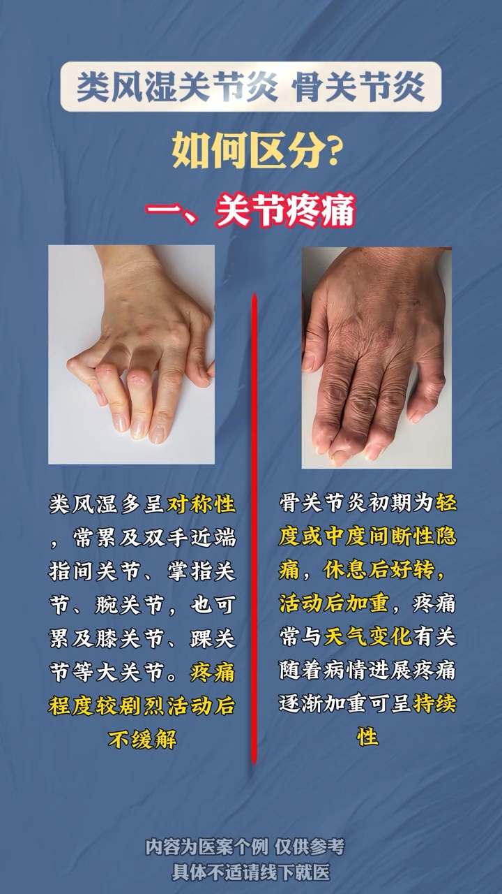 同样是关节疼痛,骨关节炎和类风湿有啥区别?